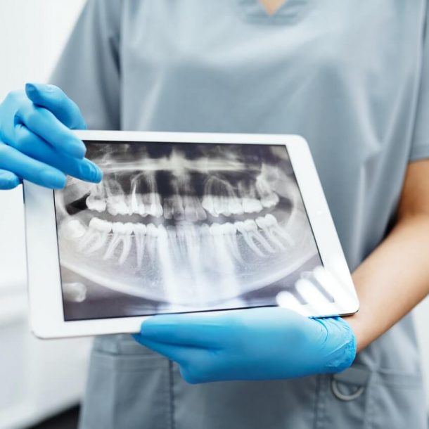 Ile kosztuje tomografia zęba?
