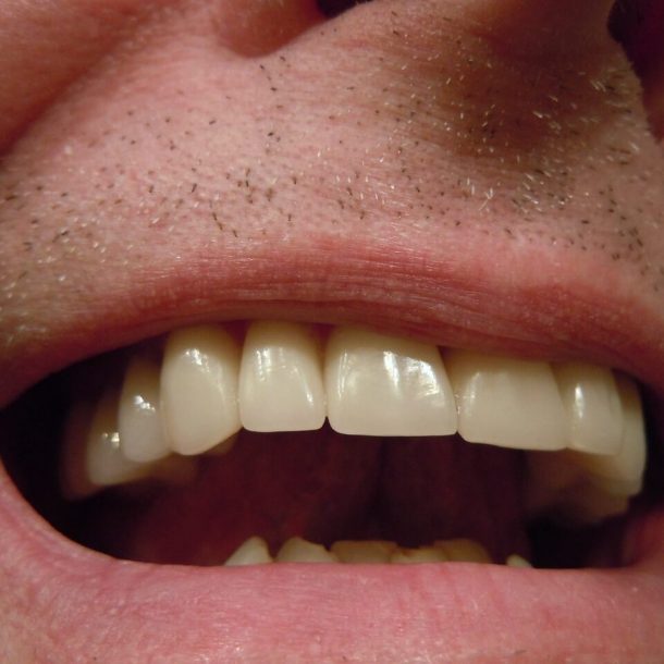 Czy wybielanie zębów lampą boli?