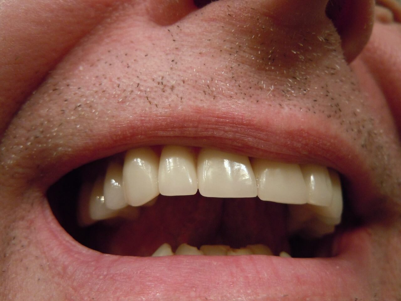 Czy wybielanie zębów lampą boli?